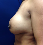 Breast Augmentation