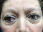 Facial Laser