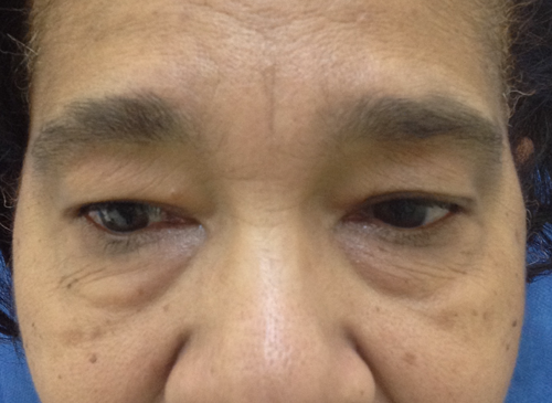 Eyelid Surgery