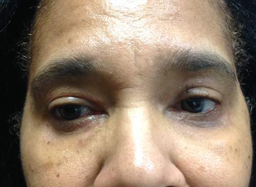 Eyelid Surgery