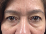 Eyelid Surgery