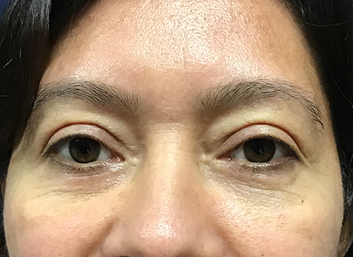 Eyelid Surgery