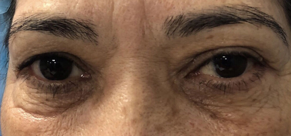 Eyelid Surgery