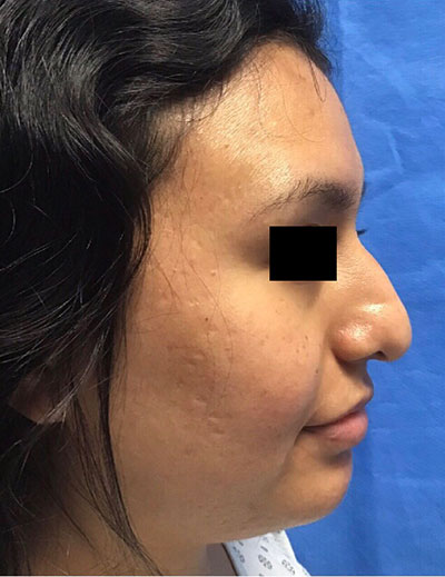 Rhinoplasty