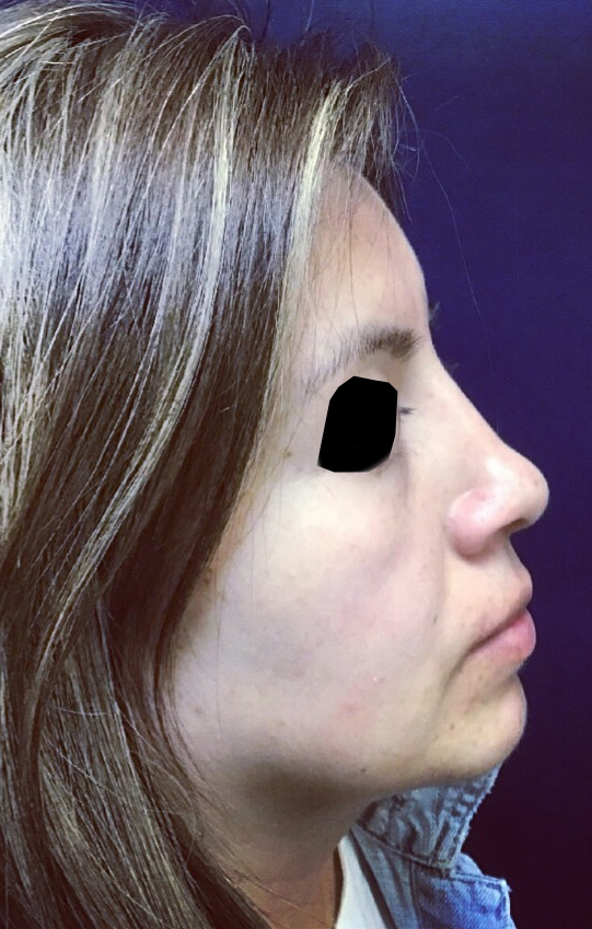 Rhinoplasty
