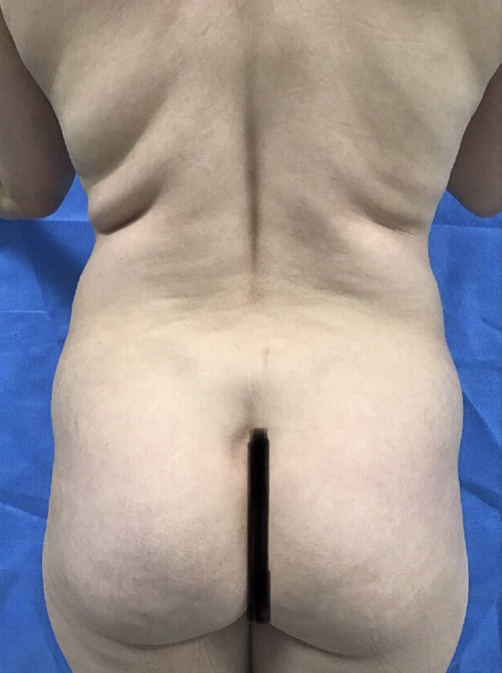 Vaser/Laser Liposculpture