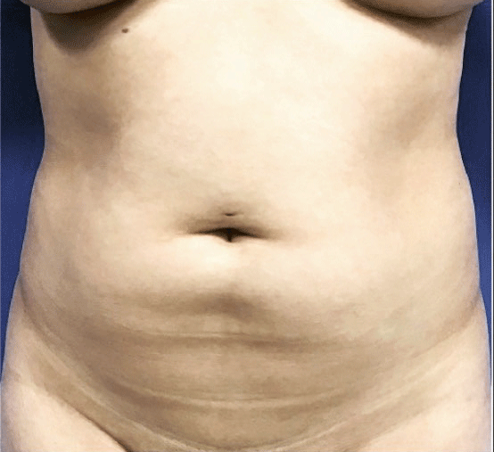 Vaser/Laser Liposculpture