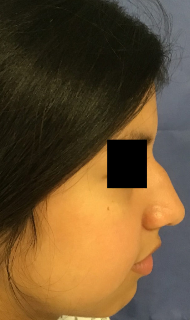 Rhinoplasty