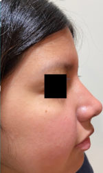 Rhinoplasty