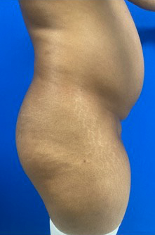 Vaser/Laser Liposculpture