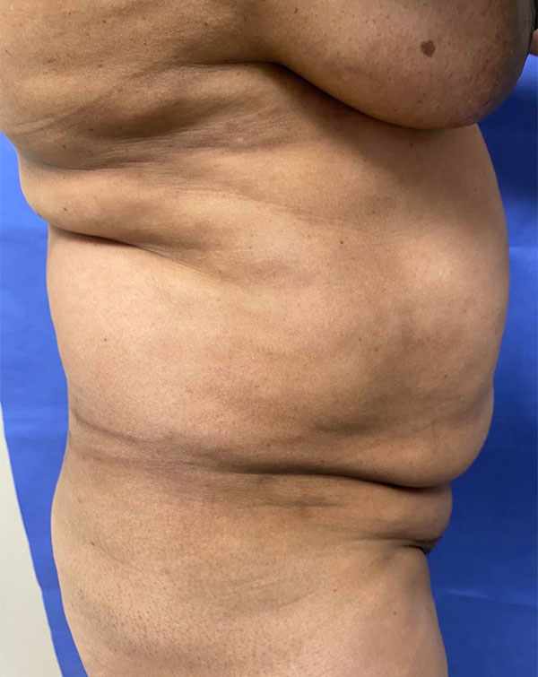 Vaser/Laser Liposculpture