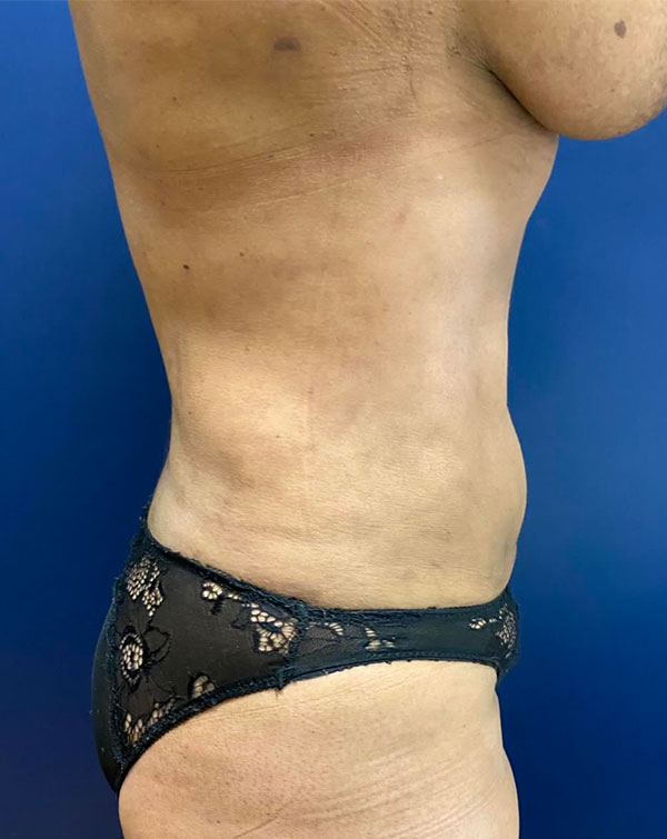 Vaser/Laser Liposculpture