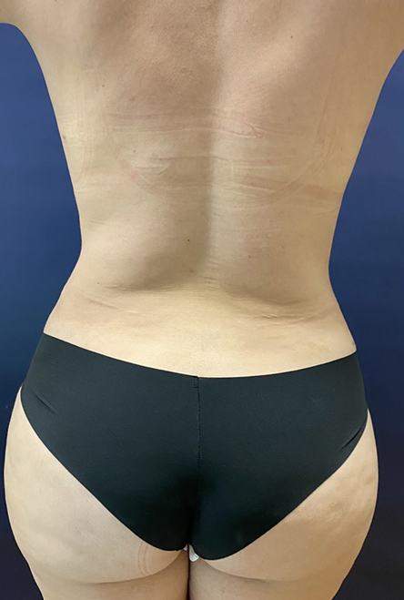 Vaser/Laser Liposculpture