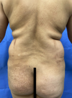 Vaser/Laser Liposculpture