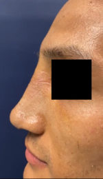 Rhinoplasty