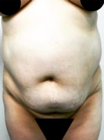 Vaser/Laser Liposculpture