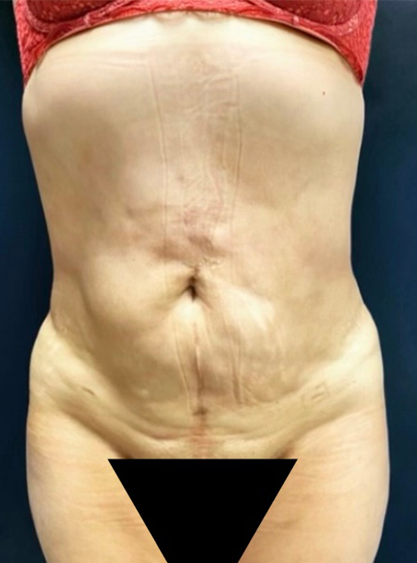 Vaser/Laser Liposculpture