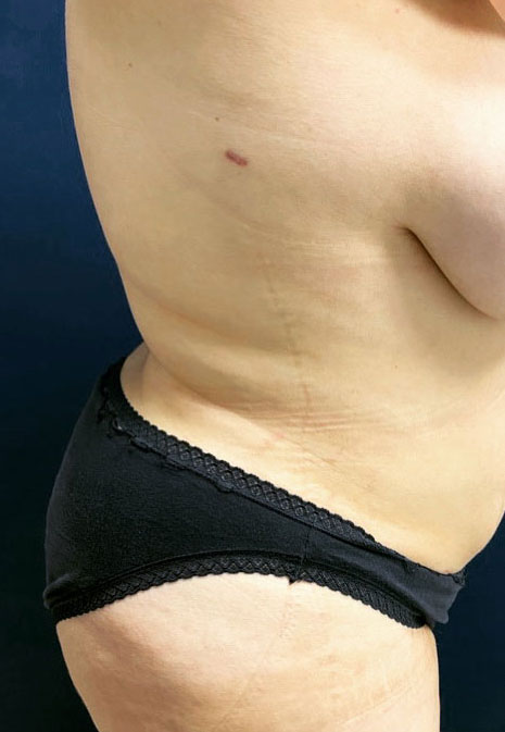 Vaser/Laser Liposculpture