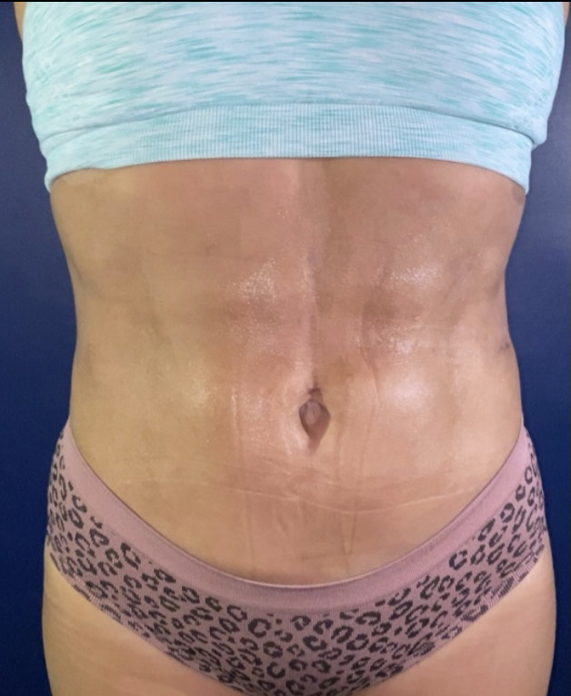 Vaser/Laser Liposculpture