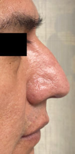 Rhinoplasty