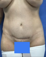 Vaser/Laser Liposculpture