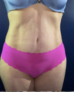 Vaser/Laser Liposculpture