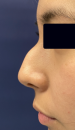 Rhinoplasty