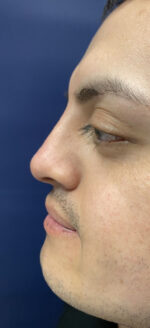 Non-surgical Rhinoplasty