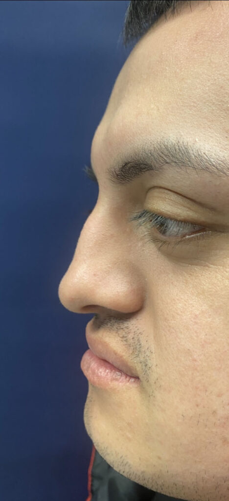 Non-surgical Rhinoplasty