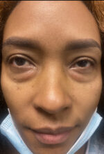 Eyelid Surgery