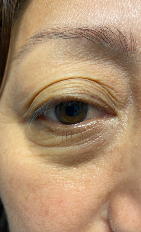 Eyelid Surgery