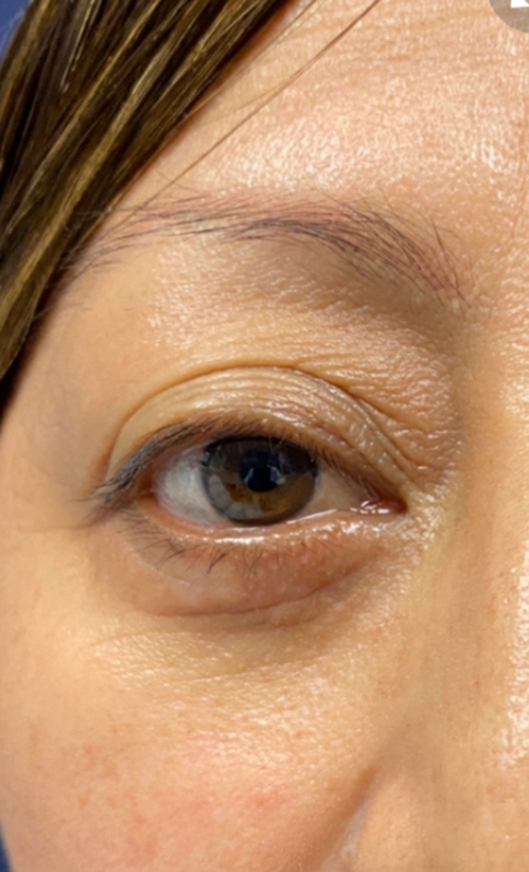 Eyelid Surgery