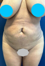 Vaser/Laser Liposculpture