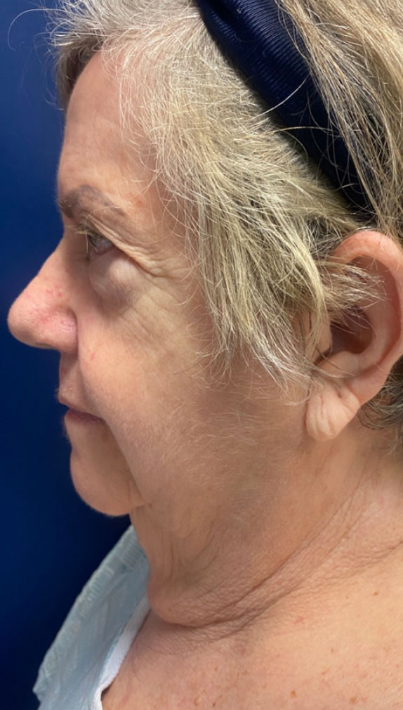 Facelift
