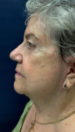 Facelift