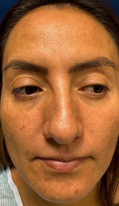 Rhinoplasty