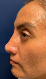 Rhinoplasty
