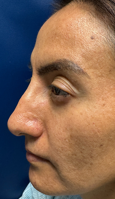 Rhinoplasty