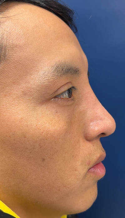 Rhinoplasty