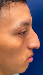 Rhinoplasty