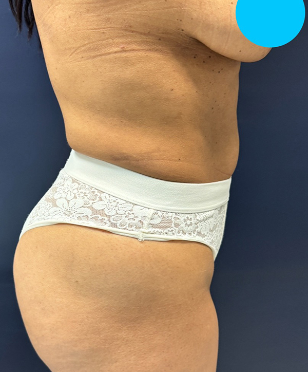 Vaser/Laser Liposculpture