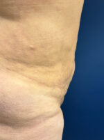 Vaser/Laser Liposculpture