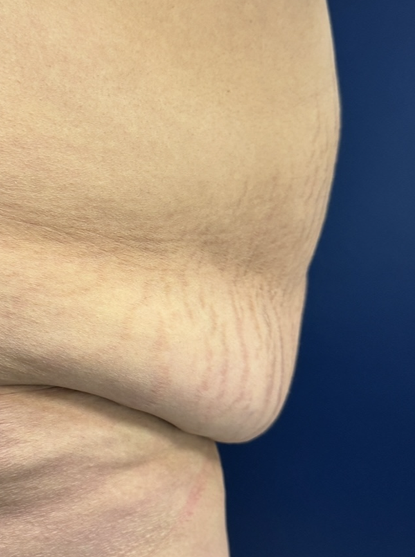 Vaser/Laser Liposculpture