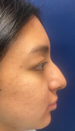 Rhinoplasty