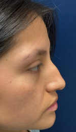 Rhinoplasty