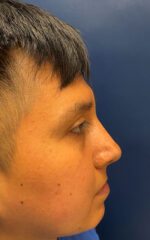 Rhinoplasty