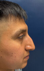 Rhinoplasty