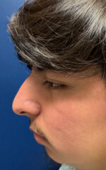 Rhinoplasty