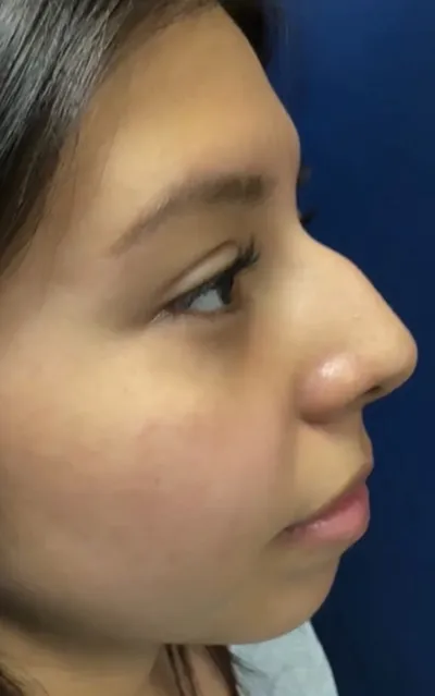 Rhinoplasty