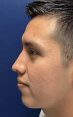 Rhinoplasty